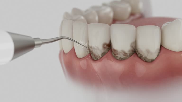 Reliable Dental Implants contractor in Boulder Hill, IL by Smile Center Dentistry